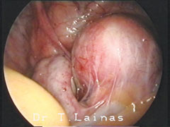 Endometriosis of the rectovaginal sectum (laparoscopic image).